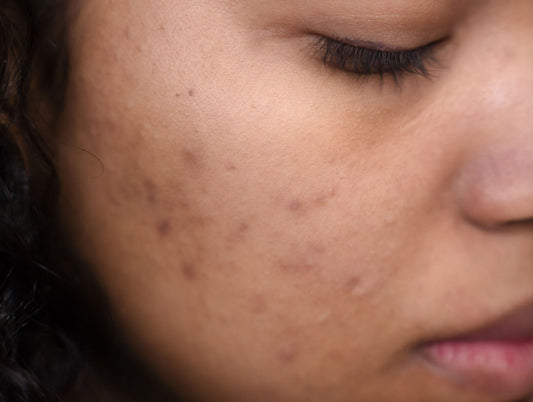El jabón de Neem: tu aliado contra el acné, las espinillas y otros problemas de la piel.